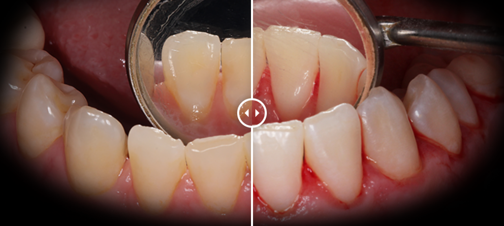 Чистка зубов (до после) - изображение 2
