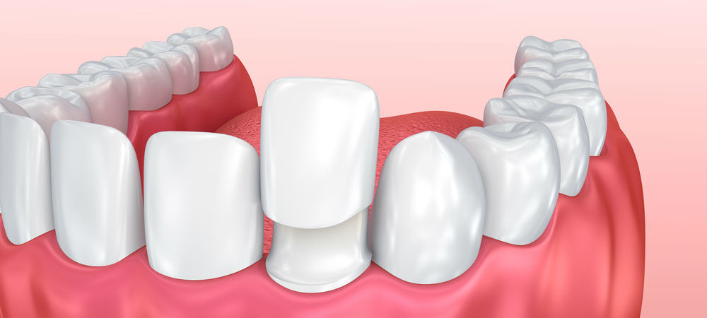 Схема несъемного протезирования зубов
