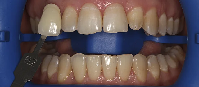 Отбеливание зубов системой Zoom 4