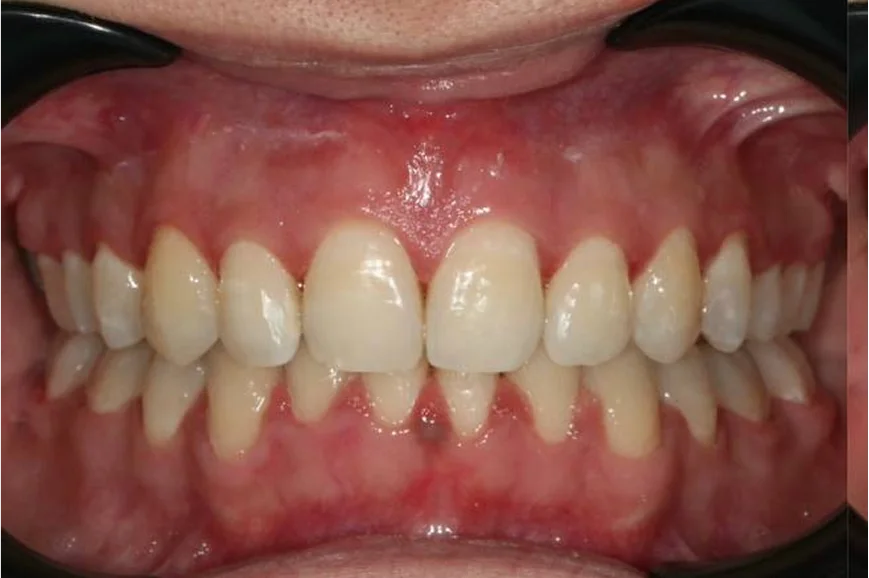 Ортодонтическое лечение на брекет-системе