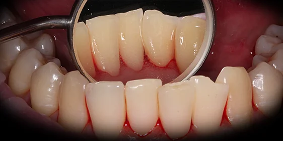 Удаление камней и профессиональная гигиена для последующего лечения кариеса