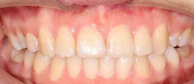 Ортодонтическое лечение на брекет-системе №1