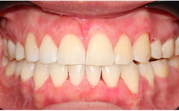 Ортодонтическое лечение на элайнерах