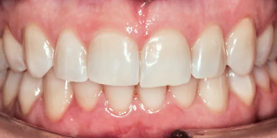 Исправление прикуса. 27 кап, 14 месяцев лечения