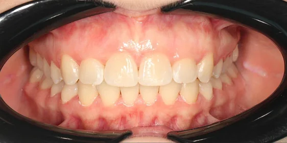 Лечение cкученности на нижней челюсти на элайнерах