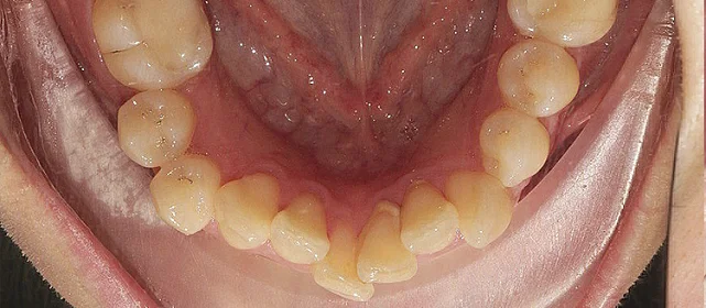 Расширение верхней челюсти брекетами