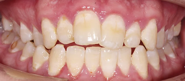 Исправление сужения верхней челюсти элайнерами