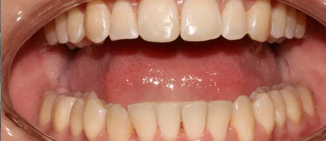 Лечение аномалии соотношения зубных дуг элайнерами