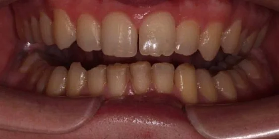 Ортодонтическое лечение на элайнерах