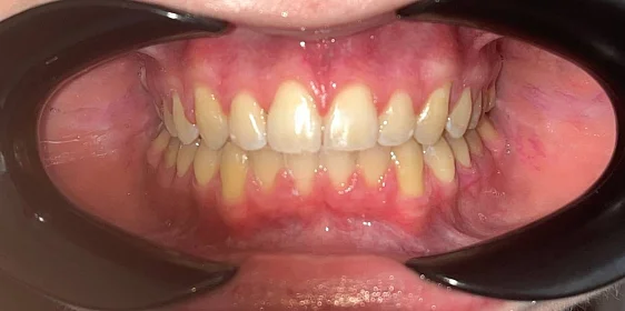 Ортодонтическое лечение на брекет-системе