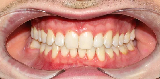 Ортодонтическое лечение на системе Click