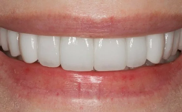 Установка виниров