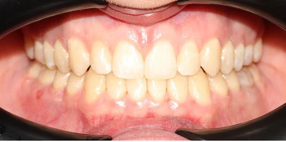 Ортодонтическое лечение на элайнерах