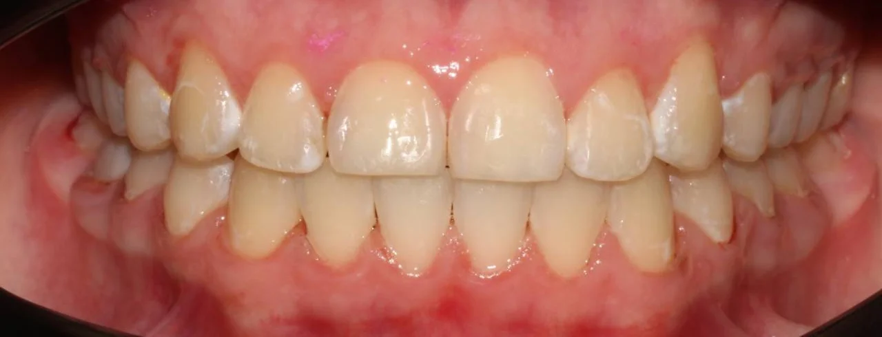 Ортодонтическое лечение на брекет-системе