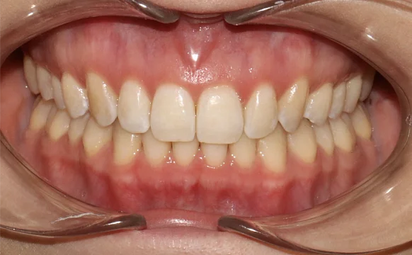 Ортодонтическое лечение на элайнерах