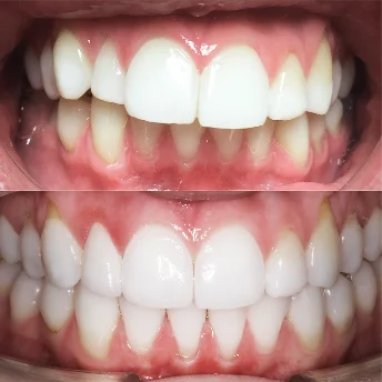 Лечение дистального прикуса с последующим ретенционным периодом