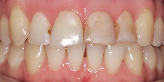 Подготовка зубных рядов к последующей установке виниров