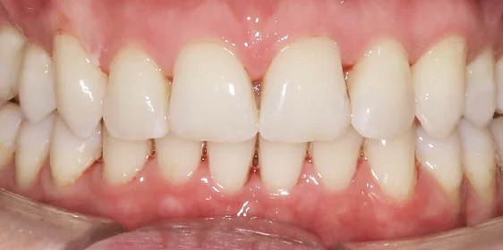 Исправление глубокого перекрытия зубов без брекетов