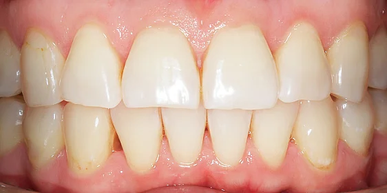 Устранение бипротрузии верхних и нижних резцов