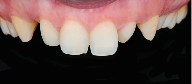 Восстановление эстетики винирами