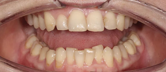 Коррекция скученности