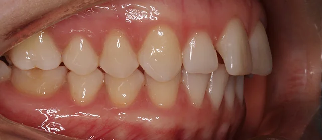 Исправление дистального прикуса элайнерами