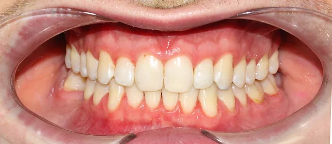 Ортодонтическое лечение на системе Click №6