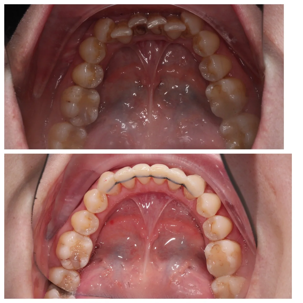 Лечение на Invisalign