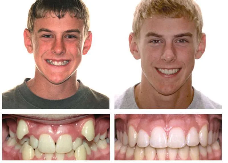 Кривые зубы у взрослого