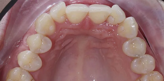 Изменение скученности зубов с помощью системы Invisalign