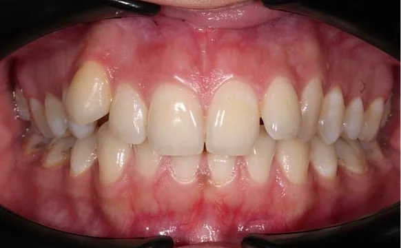 Ортодонтическое лечение на брекет-системе