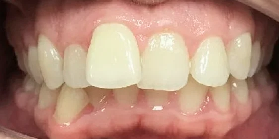 Устранение протрузии верхних резцов