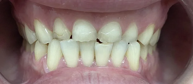 Ортодонтическое лечение №1