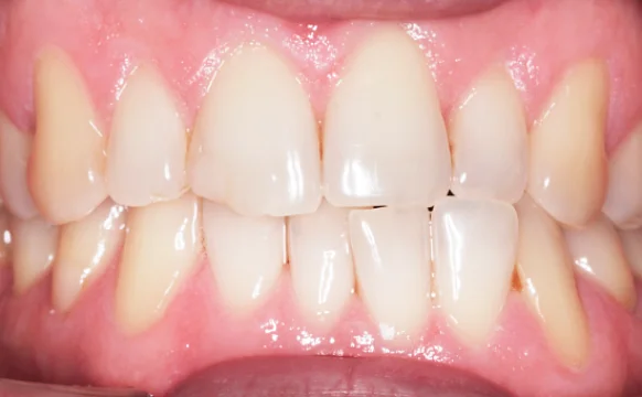 Исправление прикуса и имплантация