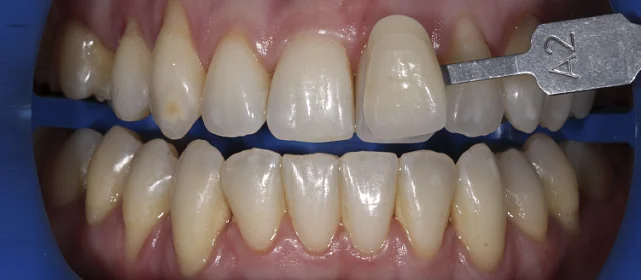 Отбеливание системой AmazingWhite