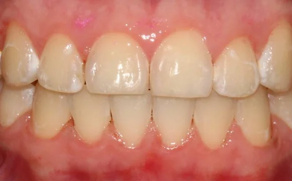 Ортодонтическое лечение на брекет-системе