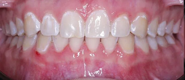 Лечение диастемы на верхней челюсти на элайнерах Click