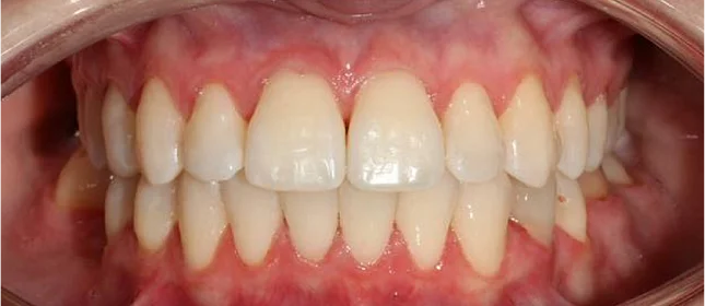 Лечение протрузии верхних резцов на брекет-системе