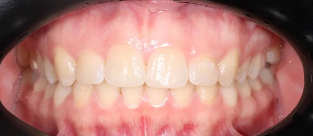 Лечение cкученности на нижней челюсти на элайнерах