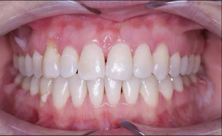 Лечение прикуса на брекет-системе