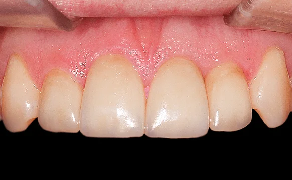 Восстановление эстетики с помощью виниров и вкладок (часть 1)