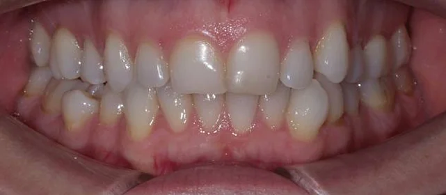 Лечение неправильного прикуса элайнерами