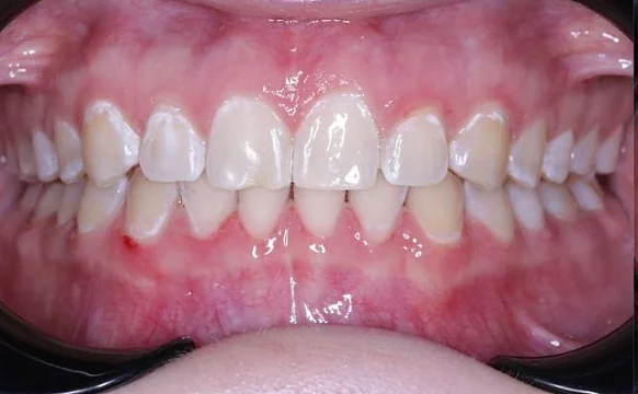 Лечение диастемы на верхней челюсти на элайнерах Click