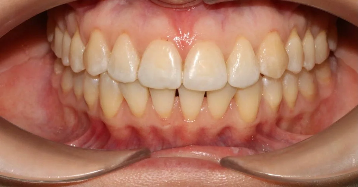 Лечение скученности зубов элайнерами