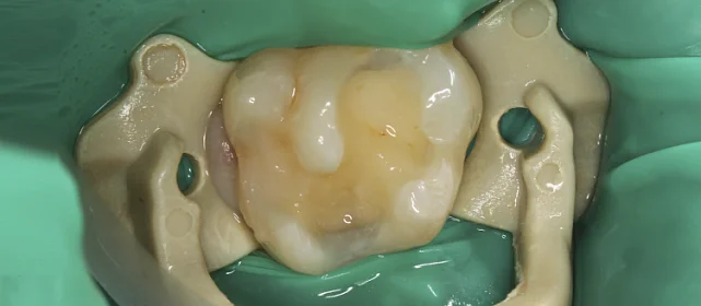 Лечение кариеса зубов