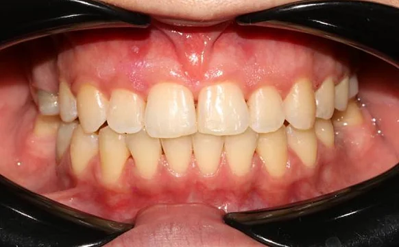 Лечение аномалии соотношений зубных дуг на элайнерах