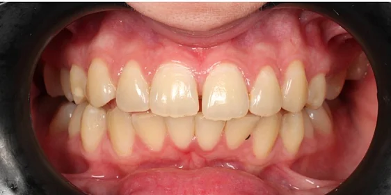 Ортодонтическое лечение на системе Click