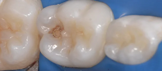 Лечение от кариеса