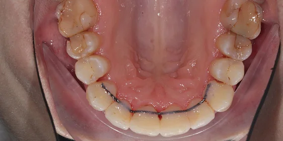 Лечение на Invisalign