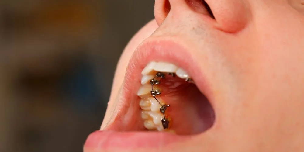 установка брекетов